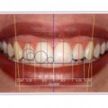 What Does The Dentist Do For Smile Design?