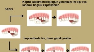 Dişim Çekildi, Ne Yapmalıyım?