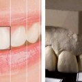 Diş Estetiğinde Gizli Şifre