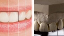Das geheime Passwort in der Zahnästhetik