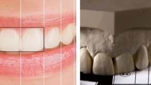 Diş Estetiğinde Gizli Şifre