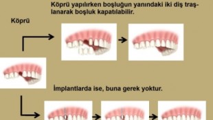 Ma dent extraite, que dois-je faire ?