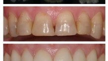 Facettes dentaires en zirconium