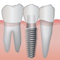 Implants (transplantation dentaire)