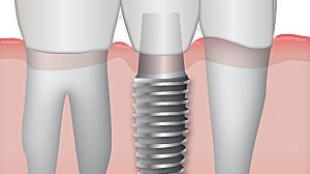 Implants (transplantation dentaire)