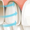 Laminate Veneer Nedir?
