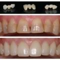 Zirconium Teeth