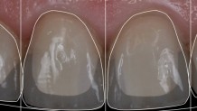 Porcelain Crowns