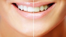 Teeth Whitening
