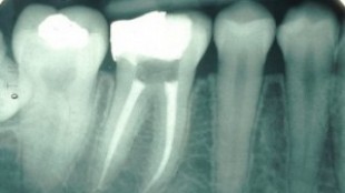Root Canal Therapy