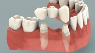 Crown and Bridge Treatments