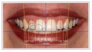 What Does The Dentist Do For Smile Design?
