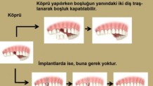 Dişim Çekildi, Ne Yapmalıyım?