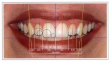 Was ist Smile-Design?