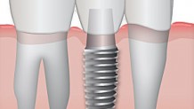 Implantate (Zahntransplantation)