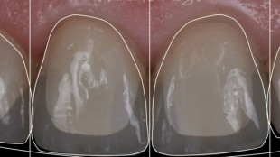 Porzellanzähne, Veneers