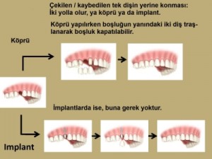Dişim çekildi. Ne yapmalıyım